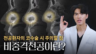 비중격천공? 천공환자 코 수술 시 주의할 점 | 늑떼선생김현주