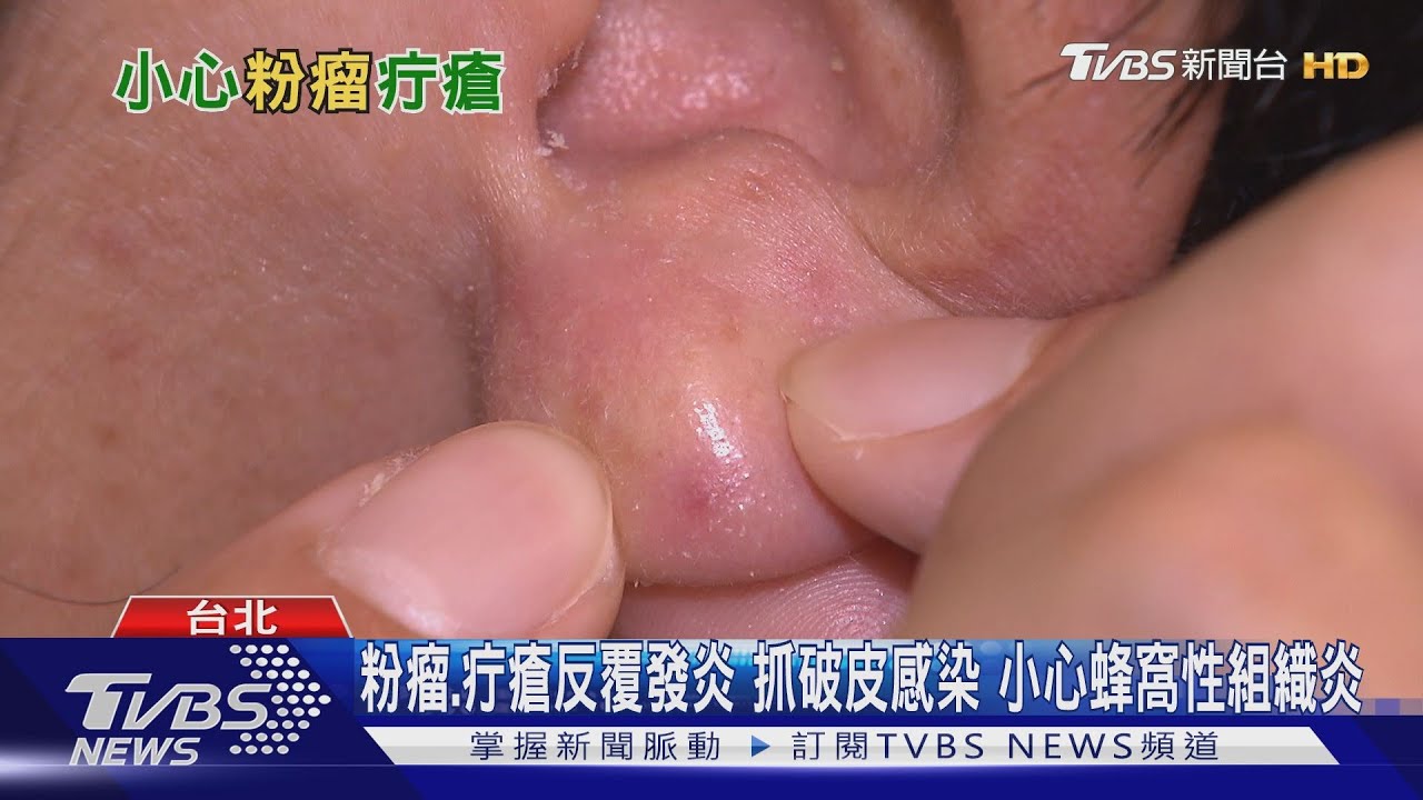 這個「病症」又癢、抓破皮細菌感染 「蜂窩性組織炎」找上門