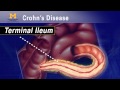 IBD School 102 - What is Crohn's Disease? 