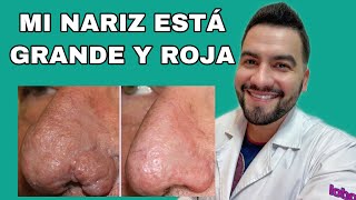 TENGO MI NARIZ GRANDE Y ROJA / RINOFIMA / ROSACEA | DR. DAVID CAMPOS