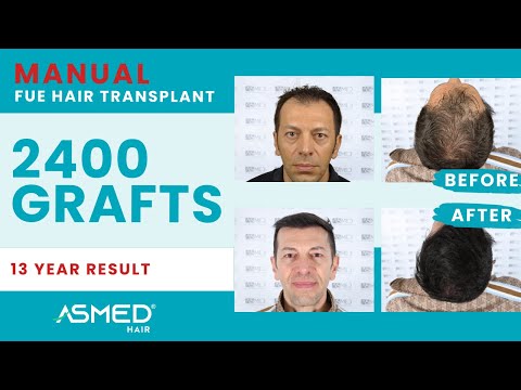 ASMED – Dr. Koray Erdogan – 2400 Grafts | 13 Years Results