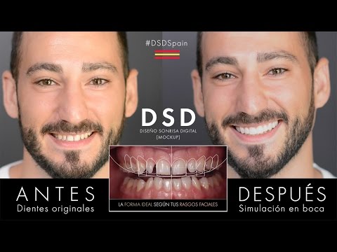 Estética Dental Inmediata - DSD Spain - Diseño Sonrisa Digital - Dr. Sergio de la Torre