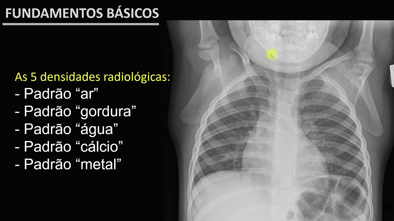 COMO AVALIAR QUALQUER RAIO X DO TÓRAX? O ABCDE DO TÓRAX - AULA 1