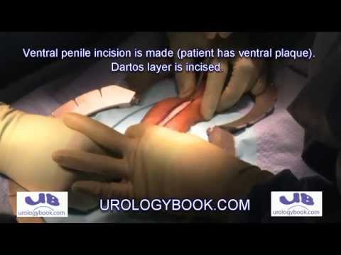 Penile Curvature Surgical Correction For Peyronie's Disease