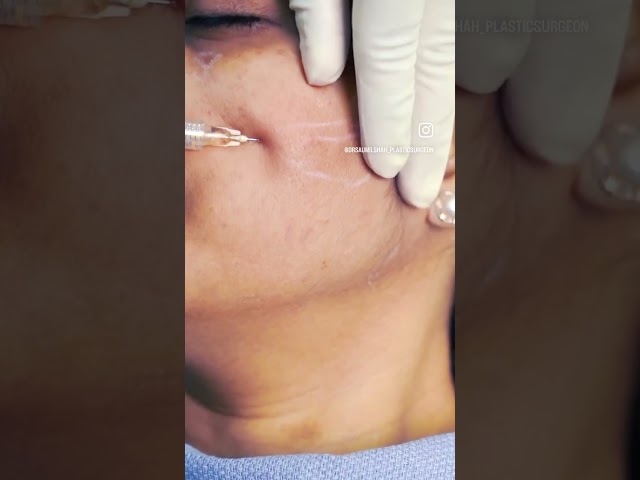 Filler Transformation