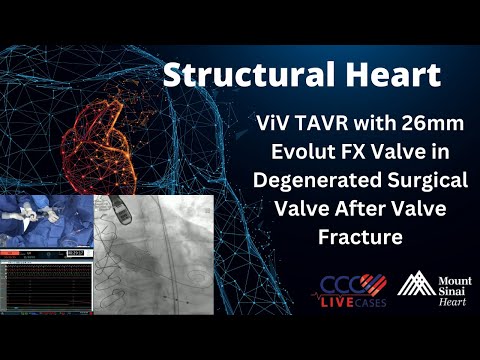 ViV TAVR with 26mm Evolut FX Valve in Degenerated Surgical Valve After Valve Fracture