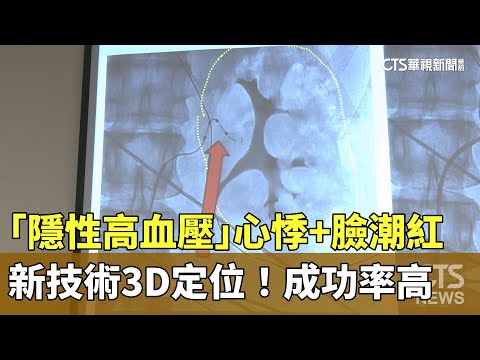 「隱性高血壓」心悸+臉潮紅　新技術3D定位！成功率高
