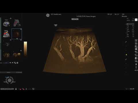 LOGIQ P9 Tutorials: B-Flow