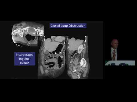 CT Bowel Obstruction: What Really Matters? | Free Radiology CME