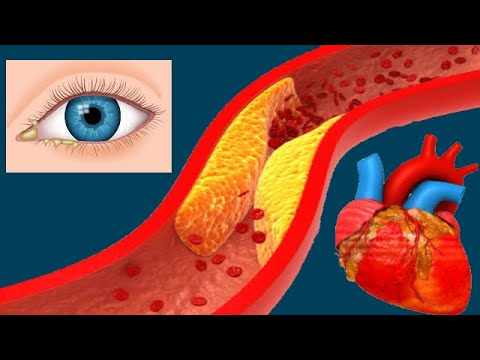 Familial Hypercholesterolemia (FH): Causes And Symptoms