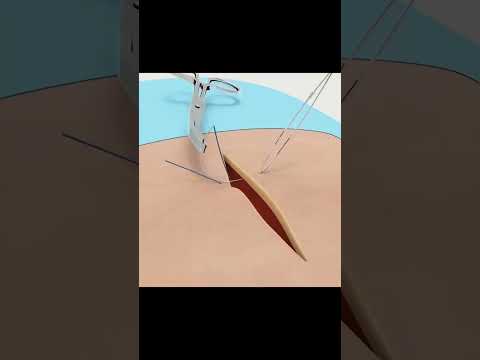 Sutures and Suturing techniques #surgery#shorts#anatomy