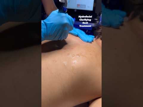 Hydrafacial Clarifying Back Treatment for Acne #hydrafacial #skincare