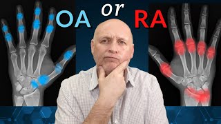 Hand Arthritis. Is it Osteo or Rheumatoid ?