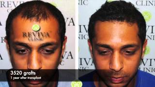 AMAZING HAIR TRANSPLANT RESULTS