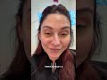 What Recovery Really Looks Like After Lower Blepharoplasty + Lipografting