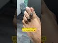 MONSTER CORNS Shorts Cornremovalsurgery