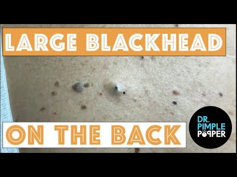 25 Grossest Pimple Popping Videos Of All Time - Zit Popping 2021