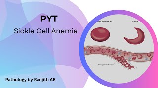 Sickle cell anemia - PYT