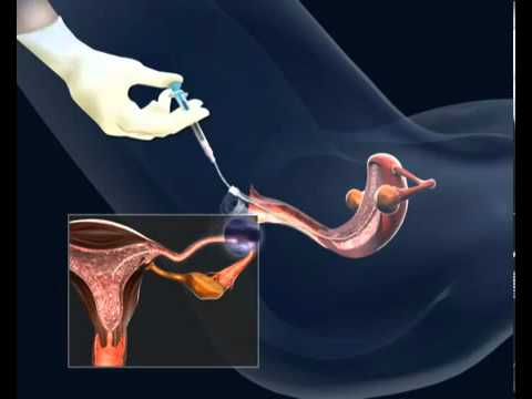 Prostata e nervosismo Supposte rettali della prostata