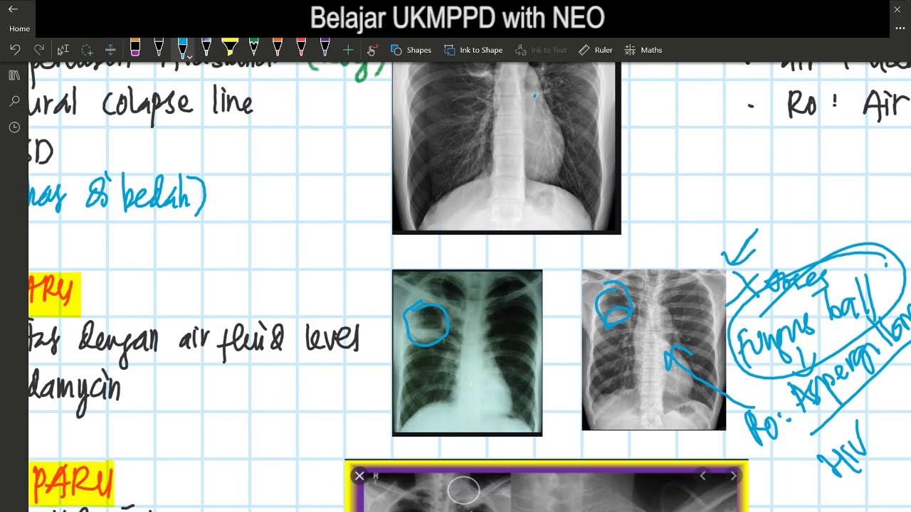 Putar video BELAJAR UKMPPD: PULMONOLOGI PART 3 (Pneumonia, Bronchiolitis et al, Pneumoconiosis, Bagossosis) sekarang BELAJAR UKMPPD: PULMONOLOGI PART 3 (Pneumonia, Bronchiolitis et al, Pneumoconiosis, Bagossosis)