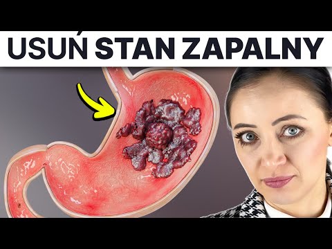 Lista * CO JEŚĆ * by usunąć stan zapalny żołądka i dwunastnicy