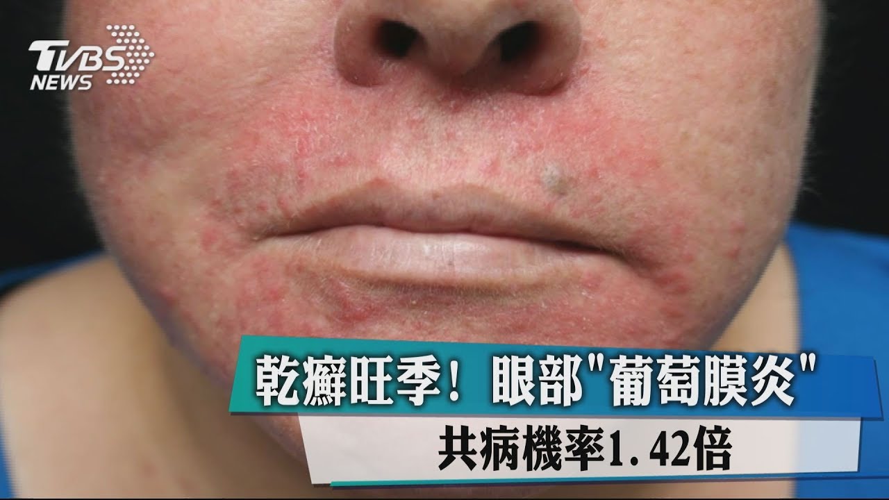 重度乾癬患者當心 眼部病變風險增加