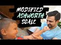 MODIFIED ASHWORTH SCALE: Review the MAS and original Ashworth Scale with me.