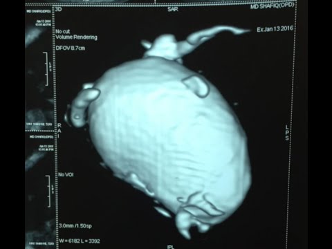 Large Choledochal Cyst in a 2-year-old Boy