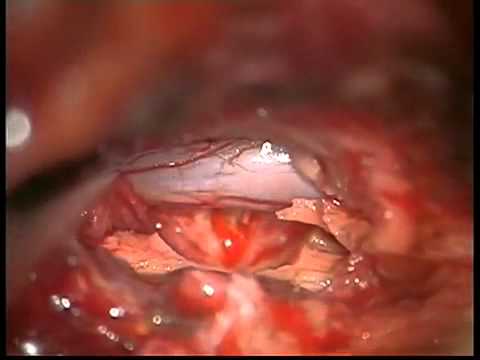 McLure per le articolazioni a strofinare McClure Come sbarazzarsi di soffocamento in osteocondrosi