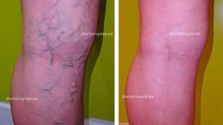 04 VARICES. Pacientes antes/después