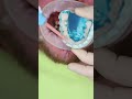 Wax Up All On 4 In Prague Shorts Dentist Dental Implant Veneers Short