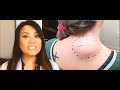 Dr Pimple Popper Attack Of The Back Lipoma This Is Zit TLC