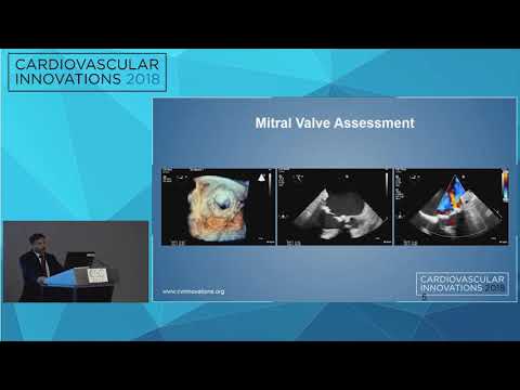 CVI2018 Session: Importance of Computed Tomography Pre-Procedural Planning - Ghazanfar Qureshi MD