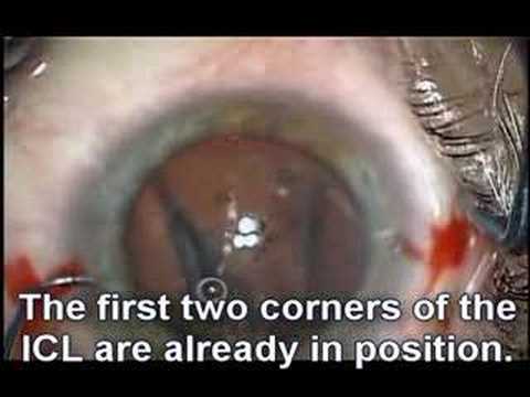 Implantable Contact Lens