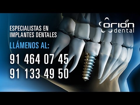 Implantes Dentales Madrid