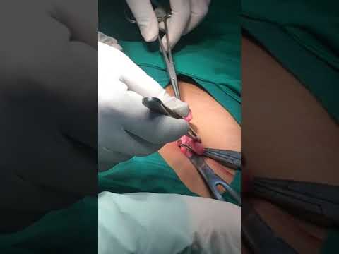 Biologically aktibong additives hindi nawawala ang timbang Slimming massage tiyan Belgorod