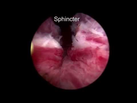 Modified Blandy’s Technique for Bipolar Transurethral Resection of Prostate