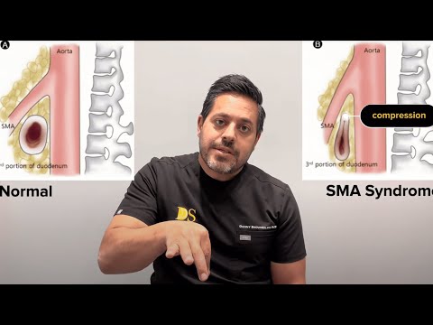SMA/Superior Mesenteric Artery Syndrome Treatment Los Angeles CA | Danny Shouhed MD