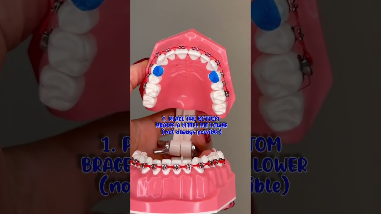 DO YOU HAVE A DEEP BITE? 🦷 TYPES OF BITES WITH BRACES / WHY BITE TURBOS ARE PLACED ON YOUR TEETH