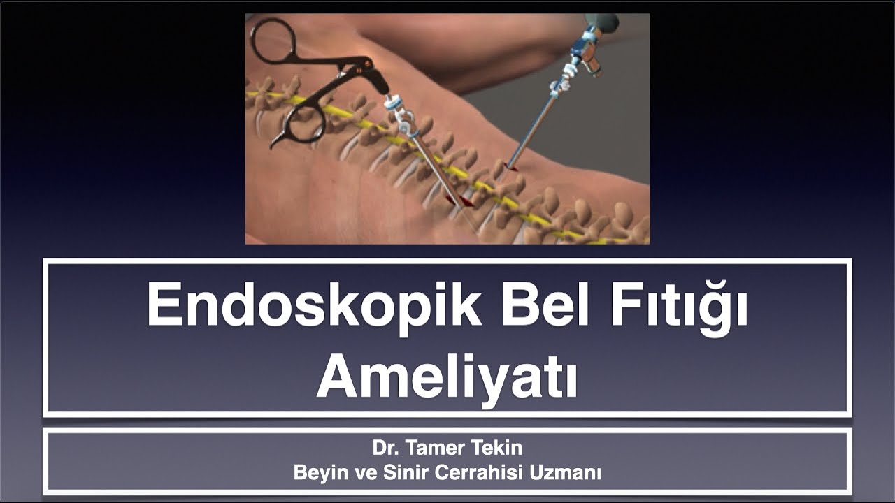 Endoskopik bel fıtığı ameliyatı