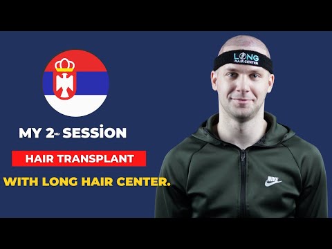 My 2nd session hair transplant with Long Hair Center.