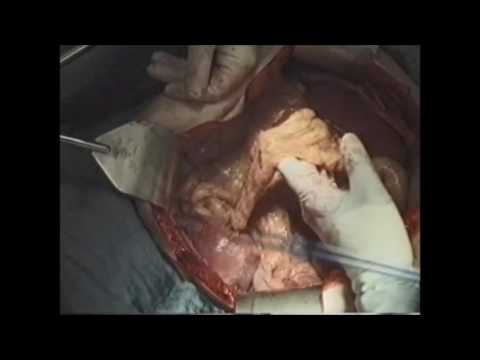 marCut® – Abdominal hysterectomy