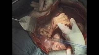 marCut® |  Abdominal hysterectomy