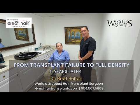 Dr. Brett Bolton's MaxHarvest Plus - 5 -Year Hair Transplant Update with Dr. Zafran