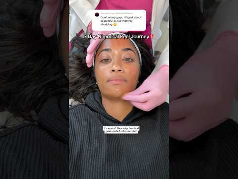 ENTIRE 7 Day chemical peel shedding process for hyperpigmentation on brown skin‼️🫶🏽 #chemicalpeel