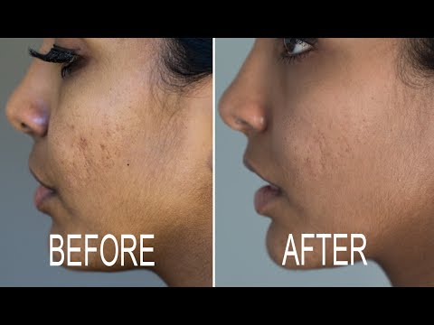 download lagu mp3 mp4 Dermabrasion For Indian Skin, download lagu Dermabrasion For Indian Skin gratis, unduh video klip Dermabrasion For Indian Skin