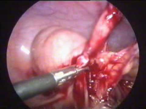 Laparoscopic appendicectomy for mucocele appendix