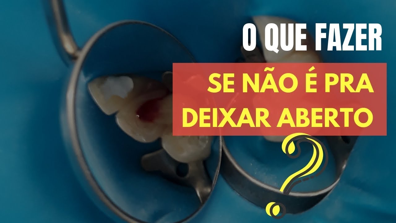 “QUANDO DRENA MUITO, O QUE FAZER AO INVÉS DE DEIXAR O DENTE ABERTO?” - QUICK TIP ENDOLOVERS