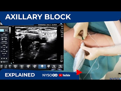 Ultrasound Guided Axillary Brachial Plexus Block NYSORA Regional Anesthesia