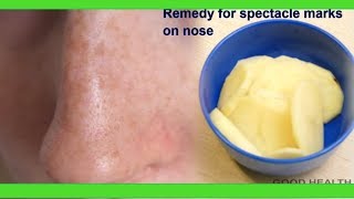 How to remove spectacle marks on nose ||  top 5 remedies ..